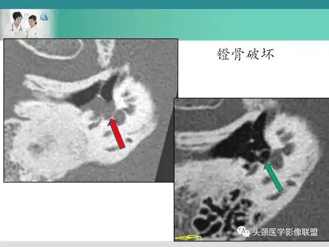 中耳解剖及慢性中耳乳突炎影像诊断与鉴别