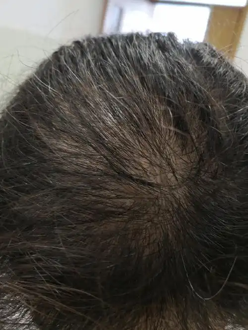 女性型脱发雄激素性脱发.可以使用药物涂擦配合理疗,注射系统治疗.