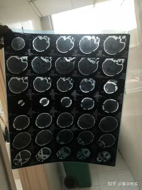 四五天的新生儿医生让做脑部ct有人可以帮我看看片子吗