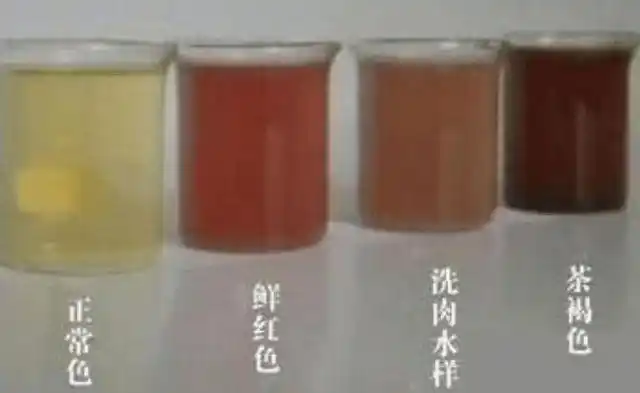 当肾结石急性发作的时候,尿的颜色就会变成深黄色,甚至呈洗肉水样的