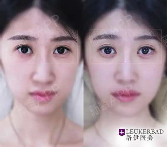 玻尿酸填充卧蚕对比照