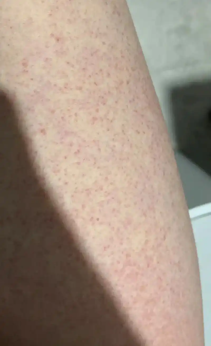 发烧都扛过去了 全身过敏终究还是没扛住啊 #病毒疹#小91人 - 抖音