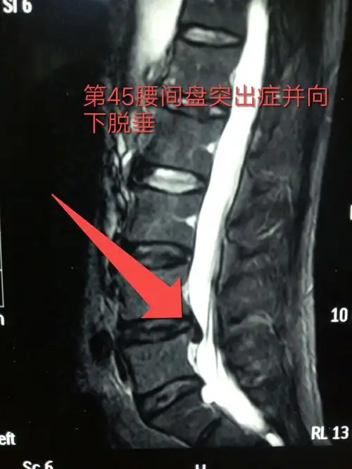 核磁共振显示突出并想下脱垂的椎间盘组织