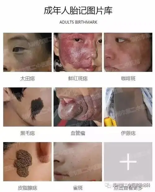 胎记专家表示,胎记从颜色上区分,就有青,红,黑,褐,蓝等区别,从病理来