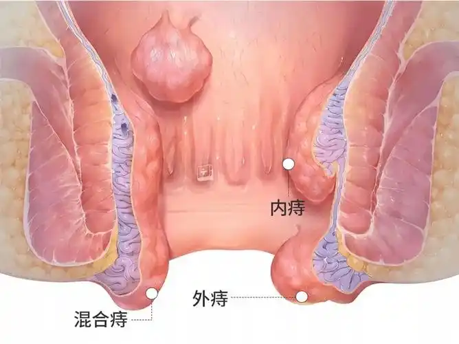 外痔的各种表现图片_有来医生