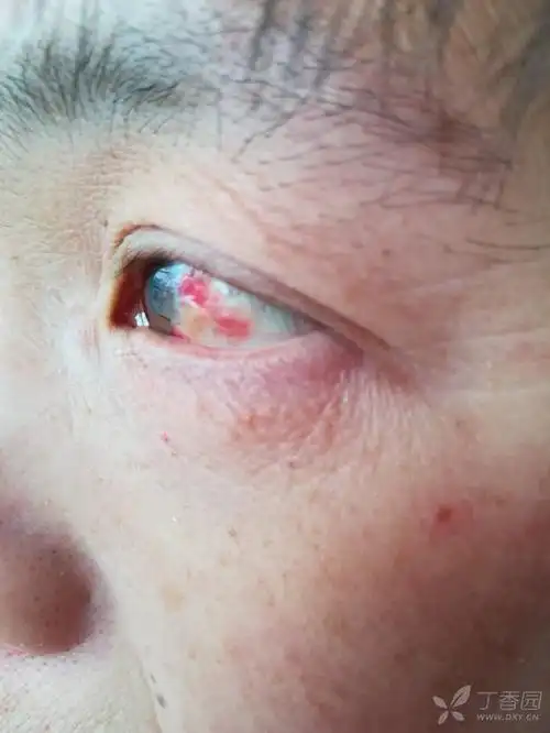 眼睛充血