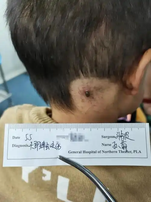 722岁小孩被蜱虫吸血多天,虫子涨大几十倍,取下来还活着蜱虫咬人,辽