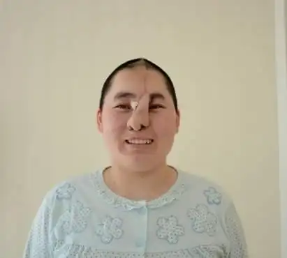 首页 潍坊新闻  由于三妮年幼就失去鼻子,现有技术手段不能完全还原原