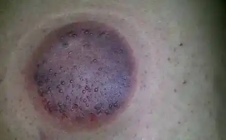 颜色不好怎么回事无论是在中医诊所还是洗浴中心,美容机构,拔火罐都是