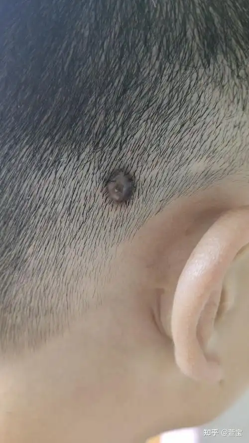 头上的肉痣瘊子开刀就后悔了