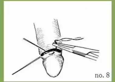 割包皮的过程是怎样的