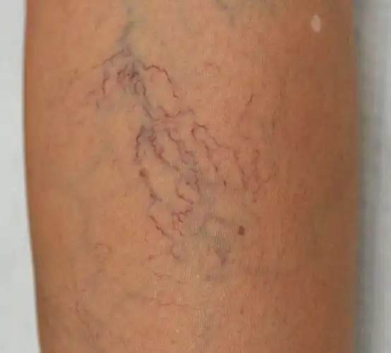 美腿杀手之静脉曲张特征篇