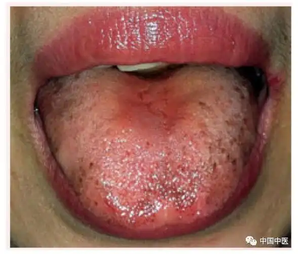 舌头下有青筋意味着什么呢