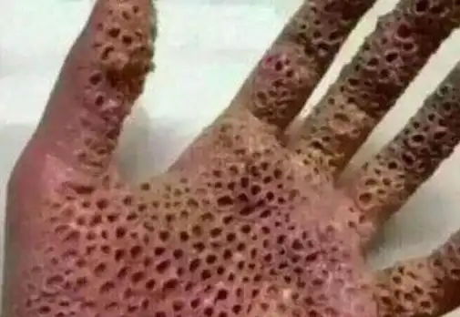 并且背部有很多红色疙瘩,让他感到奇痒无比,男孩的皮肤看起来就像癞