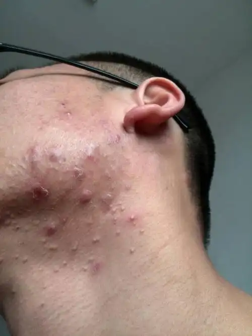 谁们帮忙解答下 这是痤疮么 这两天痒的不行不行了.