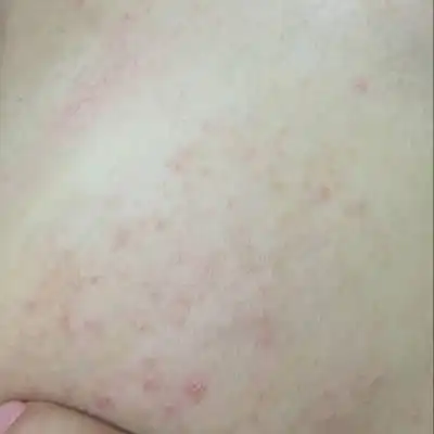 怀孕33周 乳房痒痒,可能是乳房湿疹怎麼办?