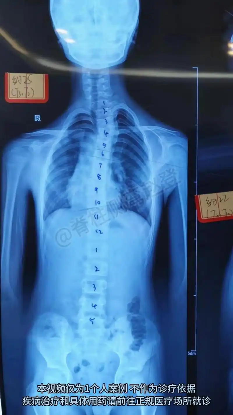 13岁小孩,目前来看度数不是很大,但是他的高低肩很明显,肩胛 - 抖音