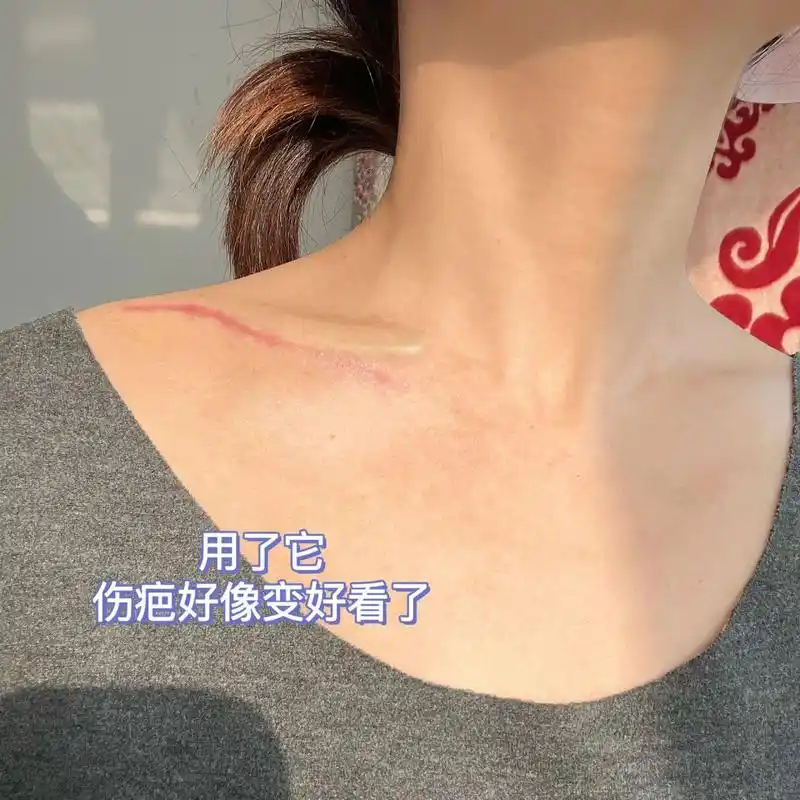 锁骨骨折术后71天|刀口伤疤可以涂碘伏护理  伤筋动