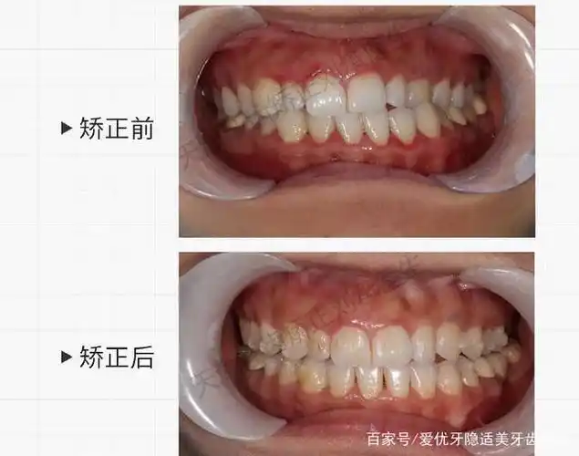 咬合偏斜导致嘴歪案例