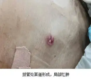 闫某,男,68岁,入院诊断为"腹腔积液".