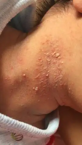 我家宝宝不知道怎么回事,脖子长了一颗一颗的,开始是