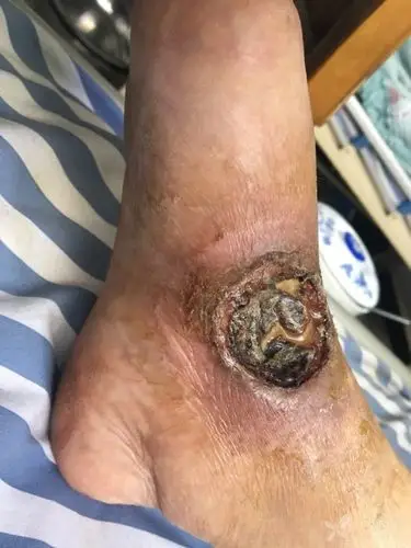 病例讨论:右足背巨大溃疡 - 皮肤与性传播疾病讨论版 -丁香园论坛