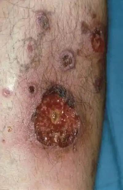 软下疳是梅毒吗