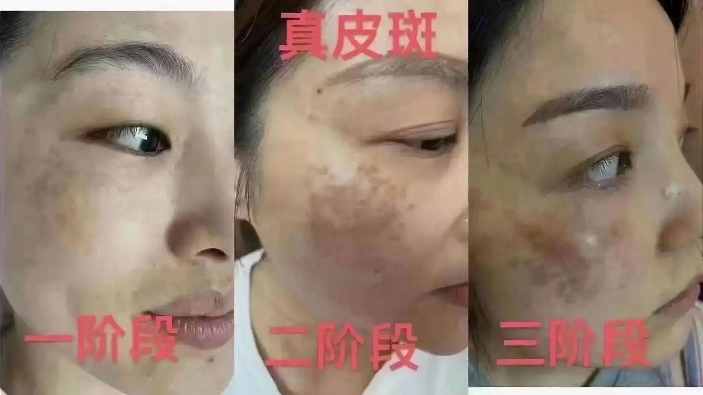 真皮斑又叫"颧骨母斑"真皮斑最可怕的是从刚开始一点点影子 - 抖音