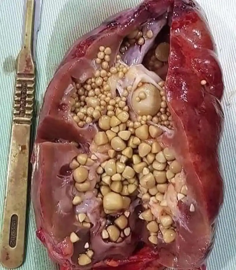 这是一枚长满结石的肾,已经失去了它原本的功能.