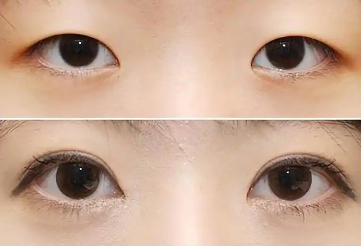 眼睛斜视怎么矫正(斜视的治疗方法有几种,一定要注意这几种方法)