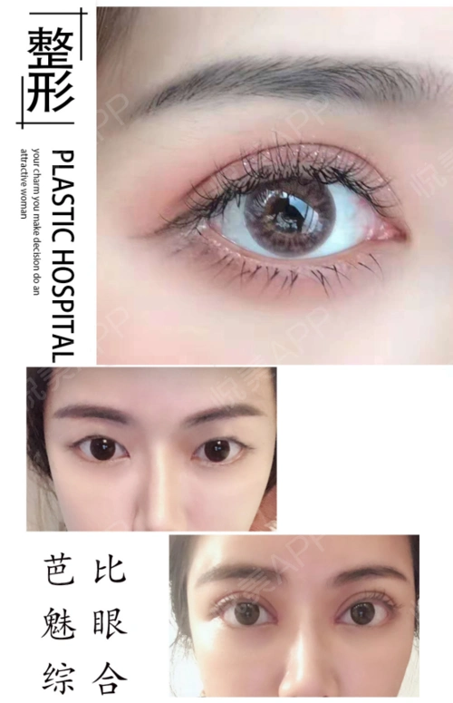 芭比眼综合整形是什么?