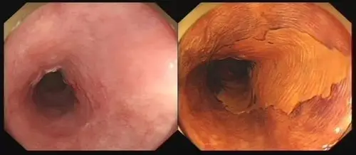 性别:女 年龄:59岁来源:门诊 检查类型:无痛胃镜检查所见:食管距门齿