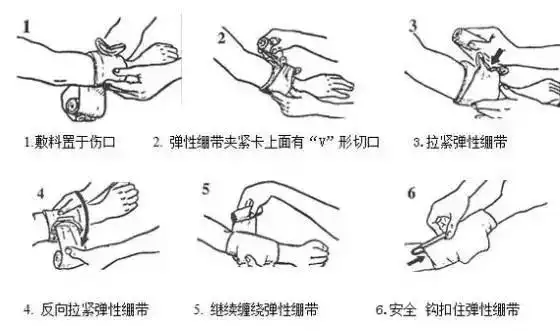 指压止血法:较大的动脉出血后,用拇指压住出血的血管上方(近心端),使