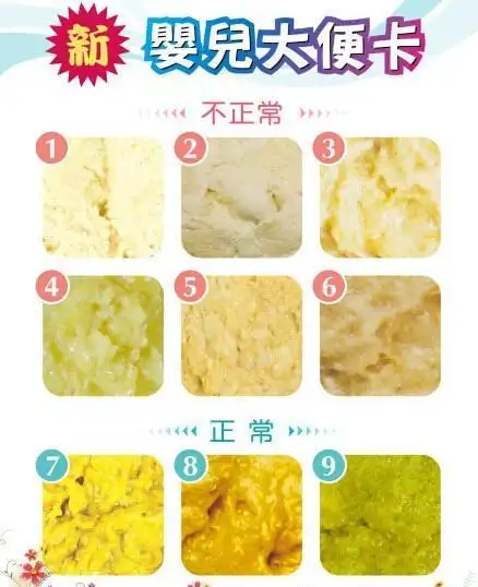 家长使胆道闭锁儿能透过大便颜色比对,及早被发现以及接受手术治疗