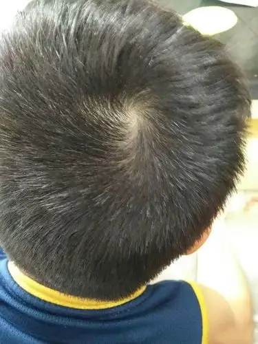 为什么有人头上只有一个旋,有人却有两个?看完才知误会大了