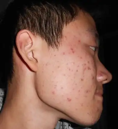 男生.脸上长很多痘痘.这是不是长疤了.该怎么消除?有图.