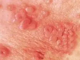 龟头炎是男性生殖器的一种疾病,对于男性的影响非常大,不管是生理还是