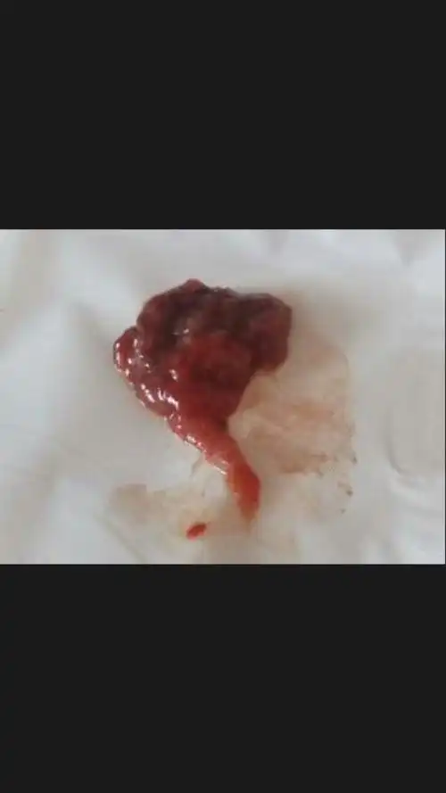 一个多月没来月经了,下面流出来了,肚子就不疼了