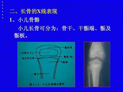 二,长骨的x线表现 1,小儿骨骼 小儿长骨可分为:骨干,干骺端,骺及 骺板