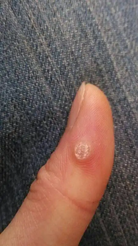 手上长了一个硬疙瘩,按下去会疼,我用刀片