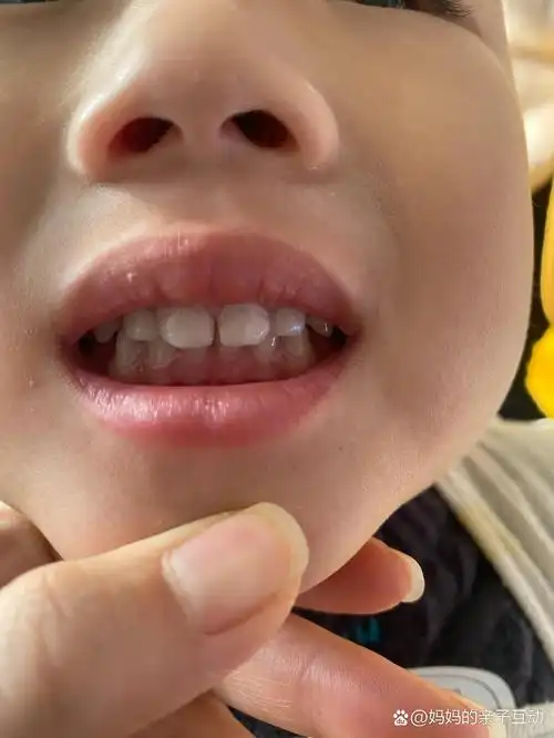 三周宝宝门牙得了龋齿怎么办 前两天刷牙发现孩子门牙中间的缝有点黑