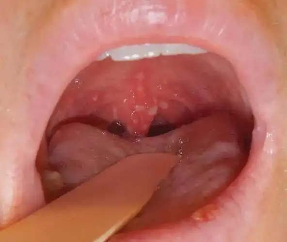 已有学校全班停课!|疱疹|脑炎|咽峡炎|症状|手足_网易订阅