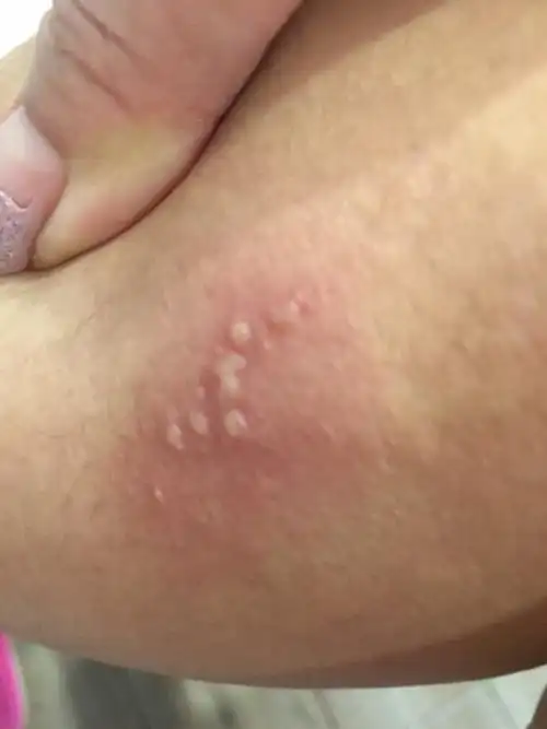 谁能知道我腿上这个水泡被什么虫子咬的!好几年了反反复复的