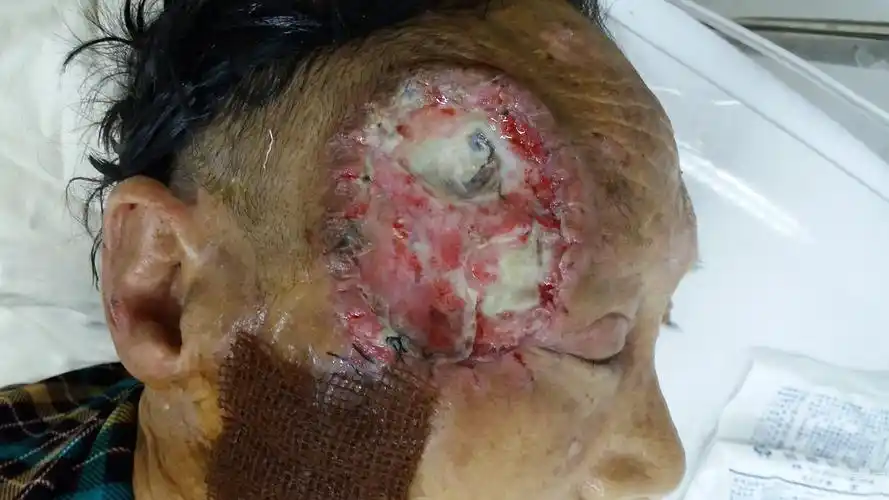 三年入院,考虑为"皮肤鳞癌",全麻下行"面部皮肤肿瘤扩大切除 植皮",术