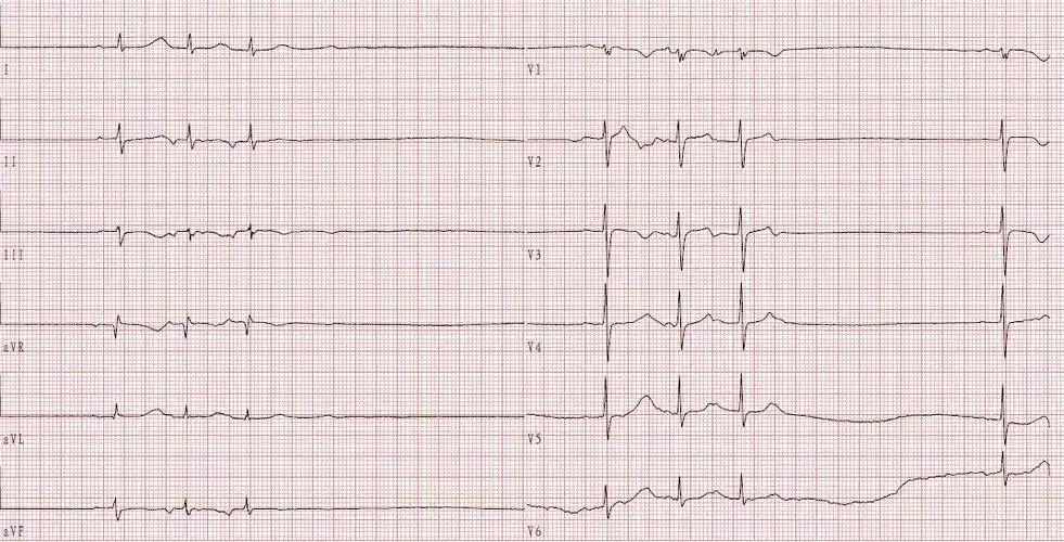 病例分享|大剂量马法兰预处理行自体造血干细胞移植治