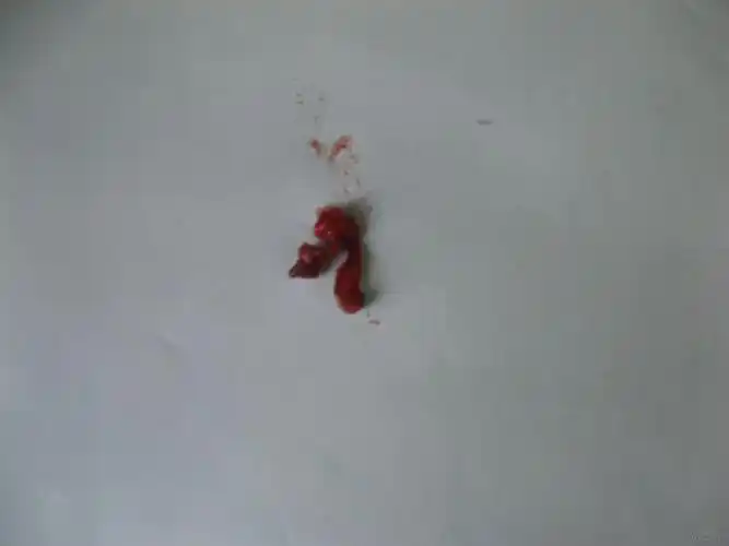 一例肛裂的诊治过程