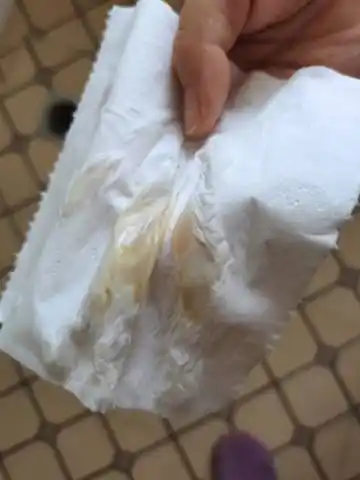 有没有宝妈孕早期出褐色分泌物的,今天孕7周5天了,昨天给宝宝洗了澡