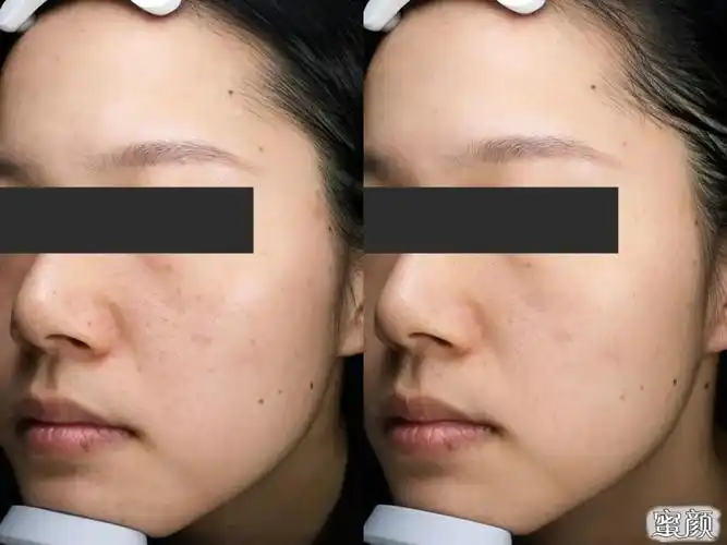 一个护肤小白的皮秒祛斑之旅
