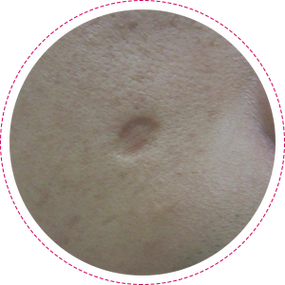 凹陷疤痕该如何修复?