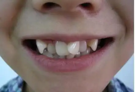 我家小孩13岁牙齿很歪很难看,我上传了图片大家帮我看看怎么办?